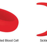 sickle cell